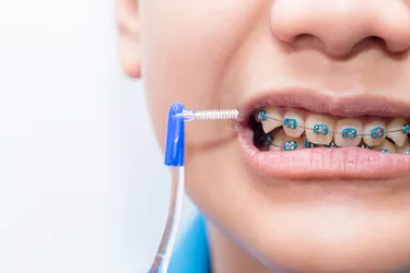 Boy cleaning his teeth brace by the brush.