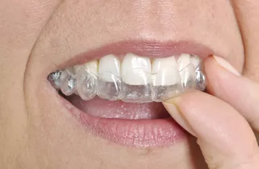 Invisible braces