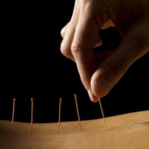 Acupuncture