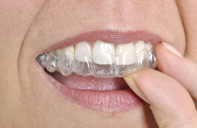 What Dental Insurance Covers Invisalign